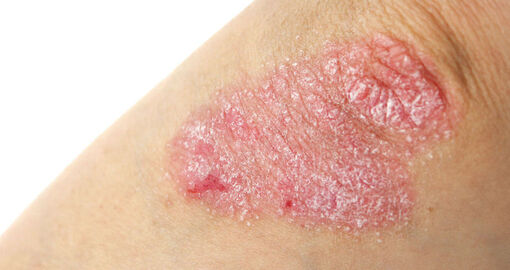Detailaufnahme einer Schuppenflechte (Psoriasis) am Ellenbogen.